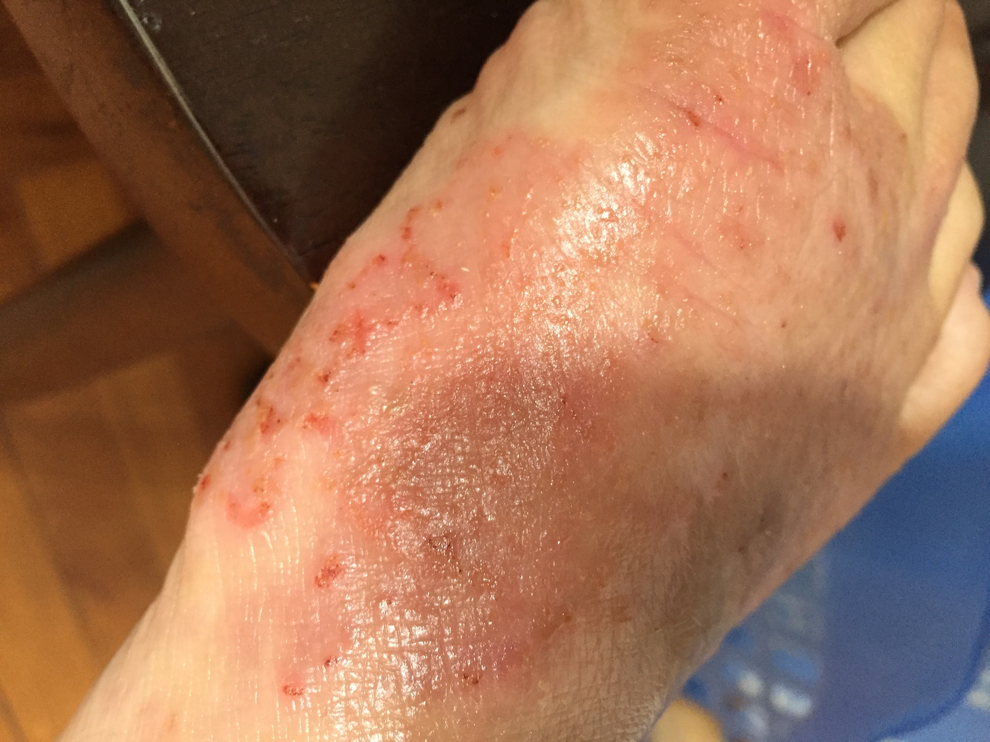 what-is-eczema-skinshare-sg