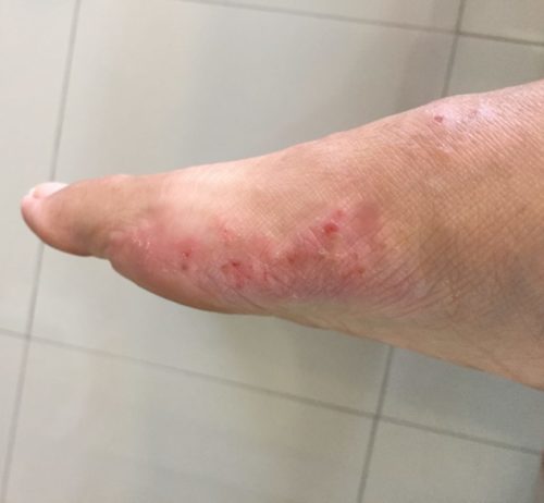 Day 0