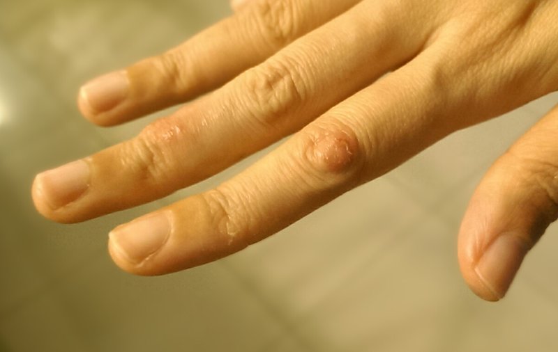 eczema knuckles topical steroid addiction