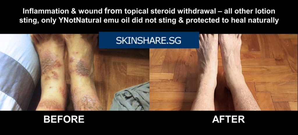 Leg eczema steroid withdrawal before after