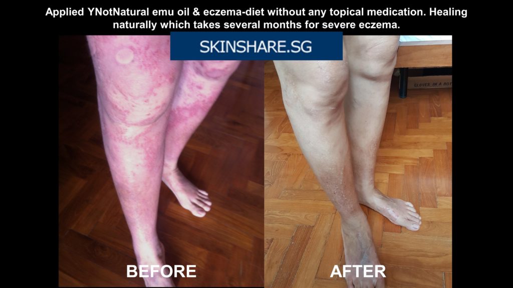 Leg eczema before after