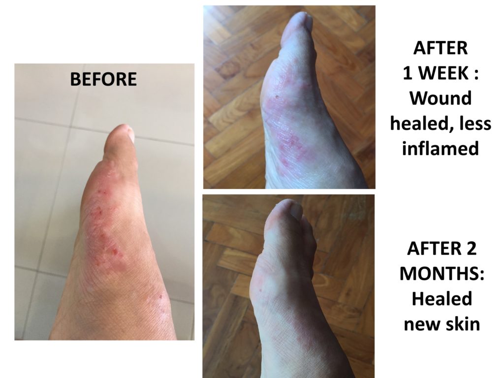 before and after eczema with kakadu plum skin ointment