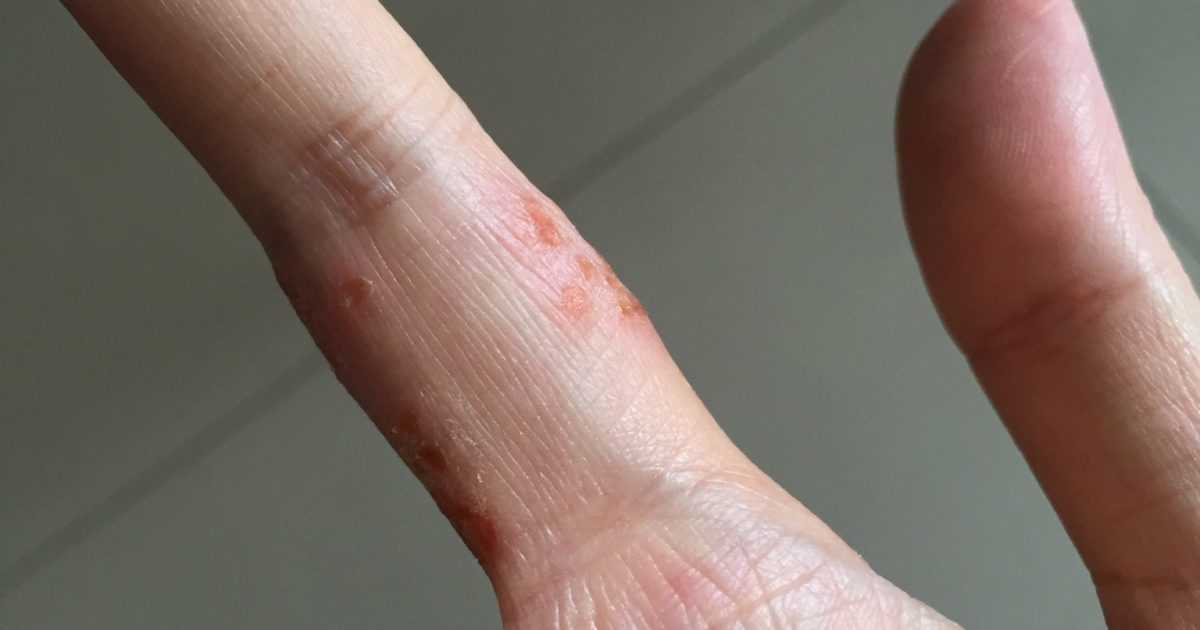 What Is Eczema? Skinshare Singapore