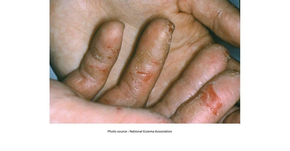 What Causes Hand Blisters Skinsharesg 