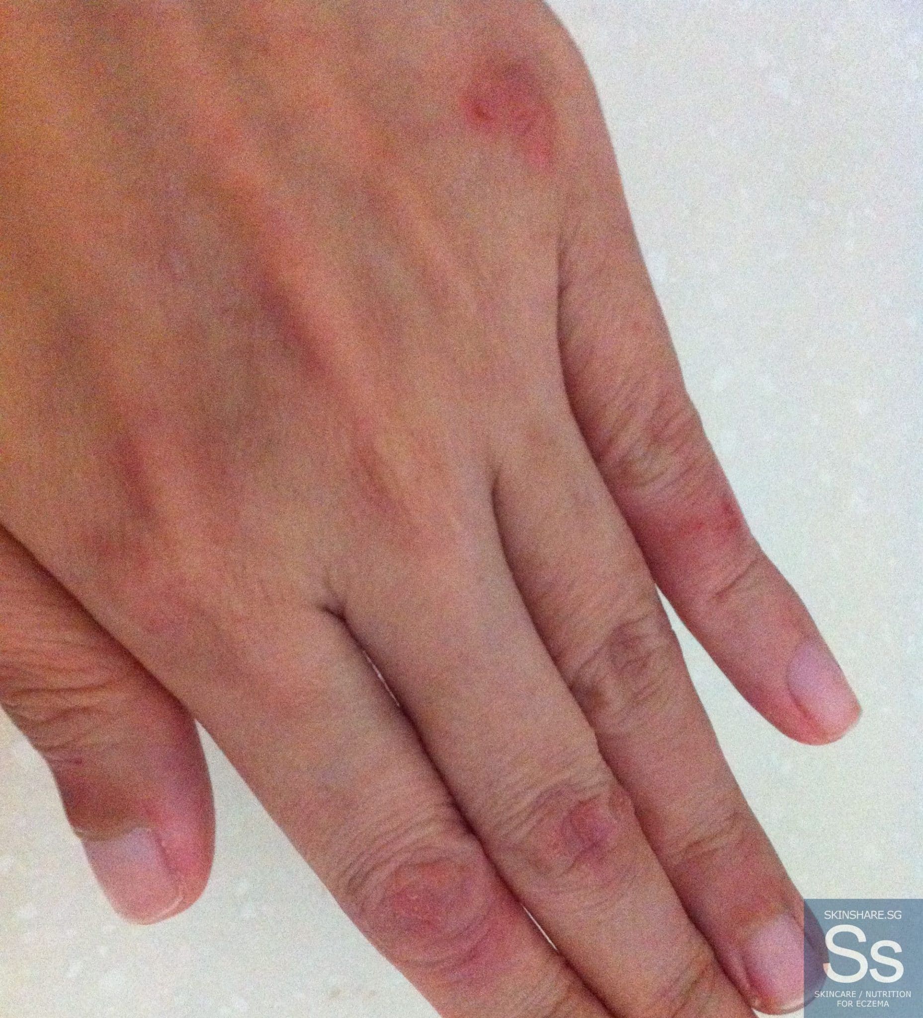 eczema-bumps-on-hands