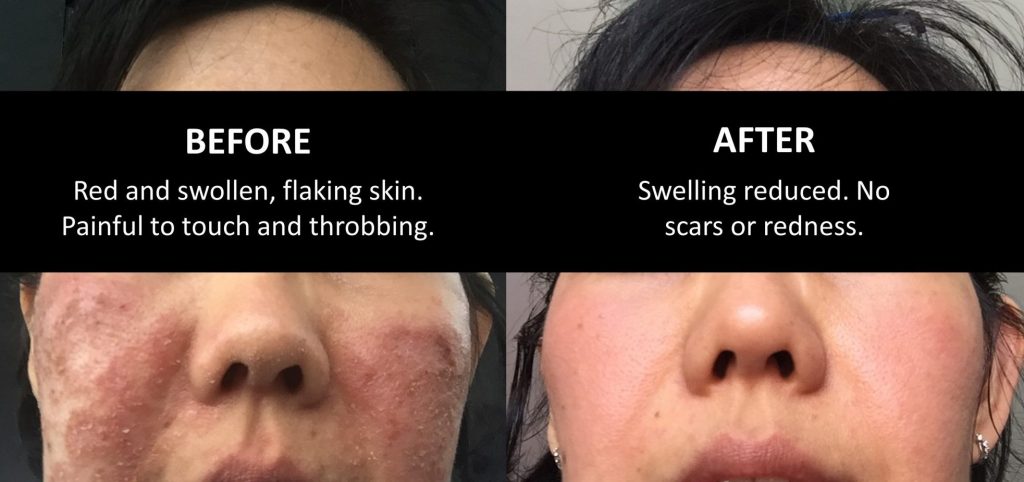 Face eczema before after