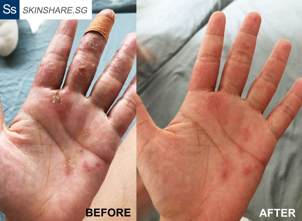 Hand eczema before and after using Argasol, emu oil and Gloves in a Bottle