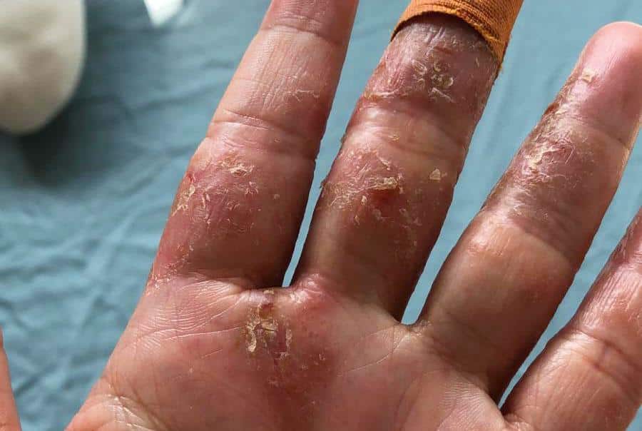 finger skin peeling