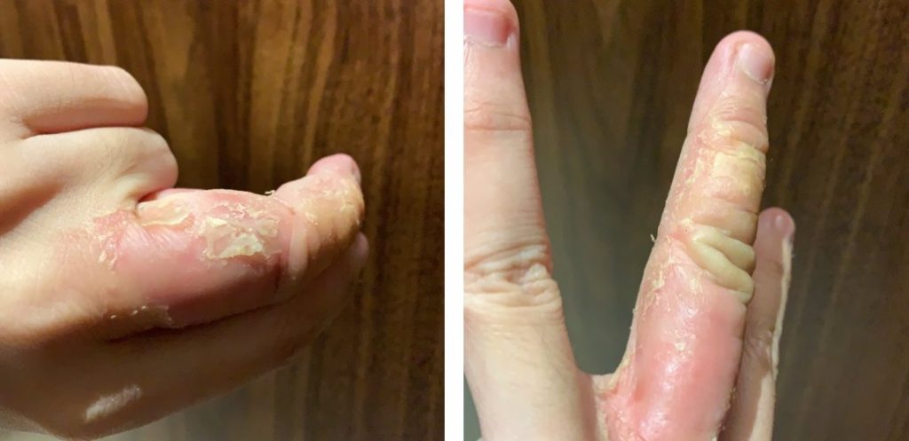 Eczema causing inflamed, peeling, cracking and itchy fingers