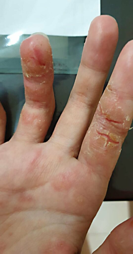 hand eczema showing cracked skin on index finger ring finger