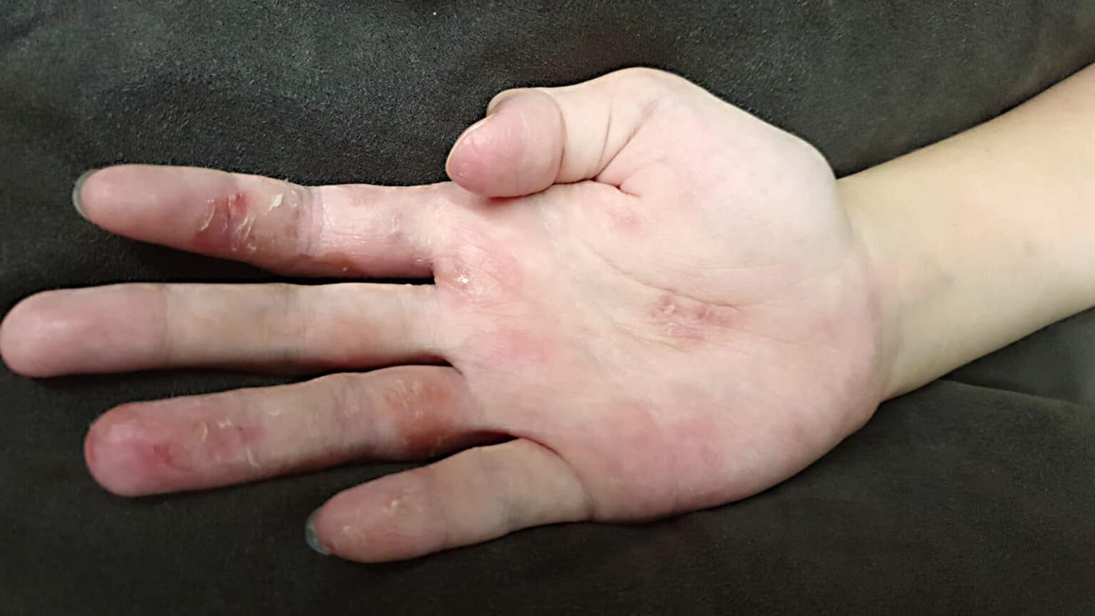 Finally healed: 8-yr old's hands were dry and cracking - SkinshareSG