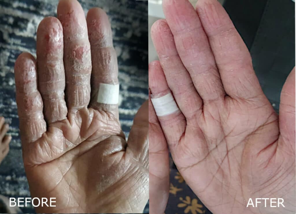 Hand eczema in elderly. LEFT: Before, cracking skin on elderly patient’s fingers. RIGHT: After two weeks: Less dry, wounds closed, less tight