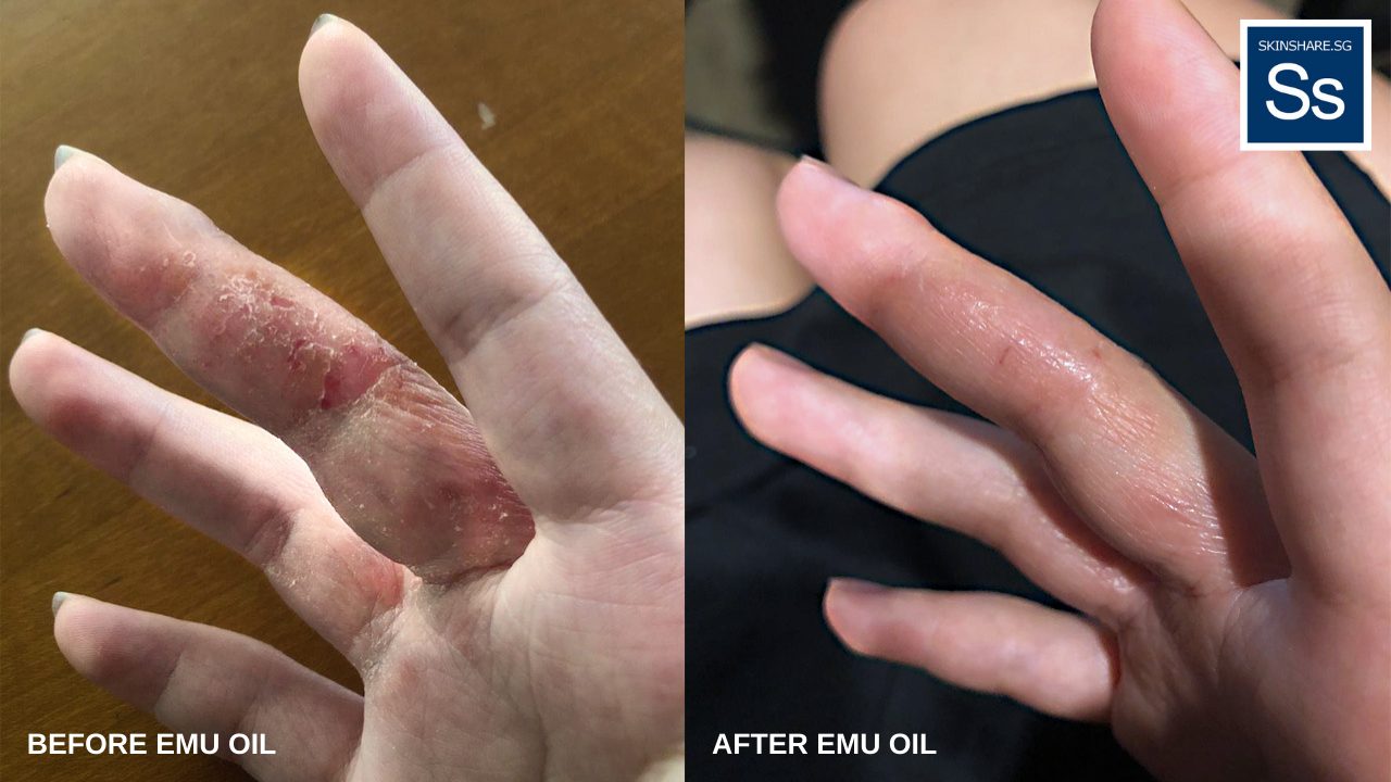 BEFORE: Dry and peeling hand eczema. AFTER: One day after applying YNot-Natural Pure Emu Oil and wearing bamboo gloves overnight. The dry and peeling skin is noticeably reduced