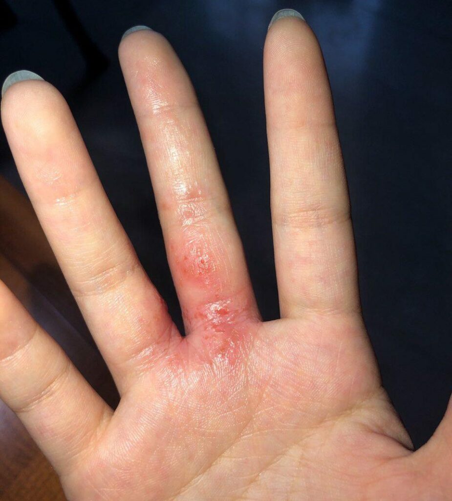 Hand eczema: weeping, dry, scaly skin