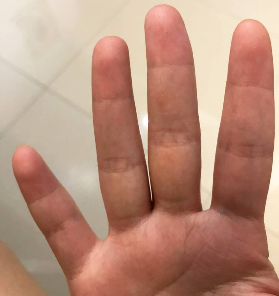 Several weeks after using emu oil and wearing bamboo gloves regularly. The skin on her hands have healed up, and she no longer needs to use steroid creams to control her flare-ups