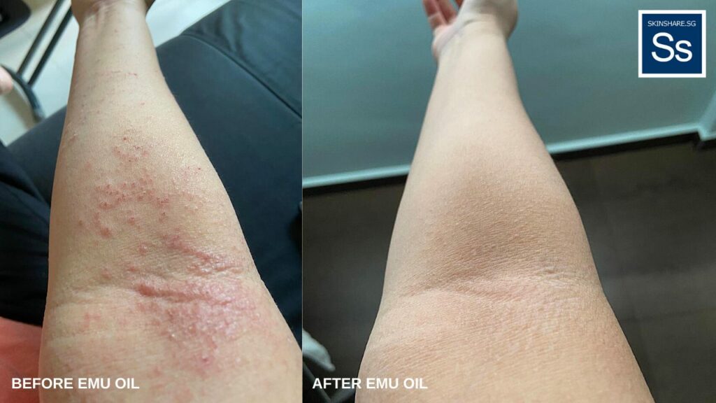 Eczema before and after on Janice’s right arm. The redness is gone, and the itchiness has calmed down.