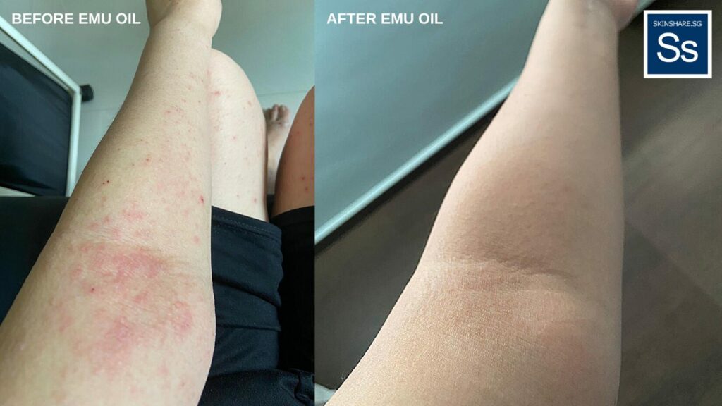 Above: Before and after eczema on Janice’s left arm.