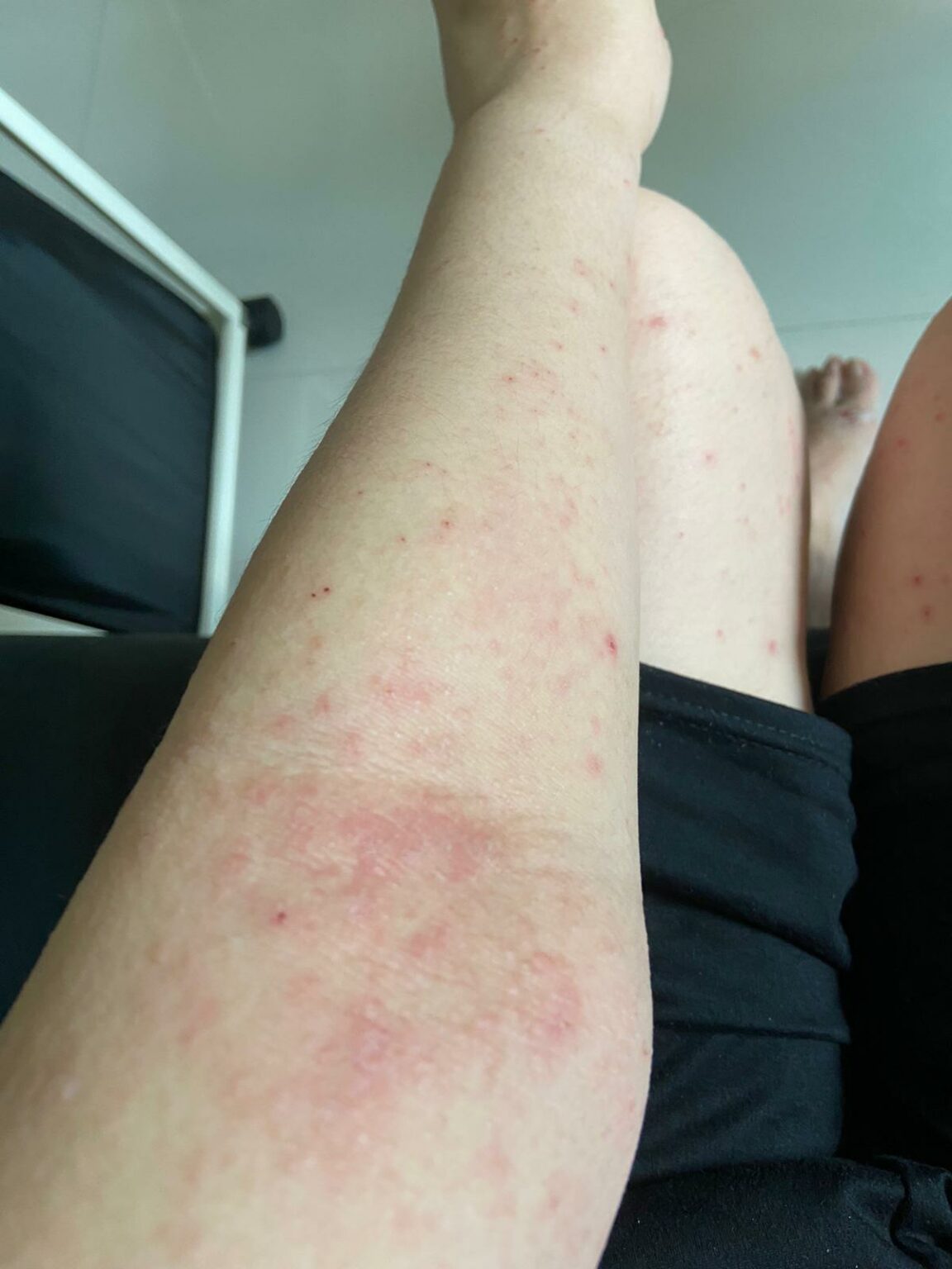 Woman was afraid to bathe because her eczema stung so badly - SkinshareSG