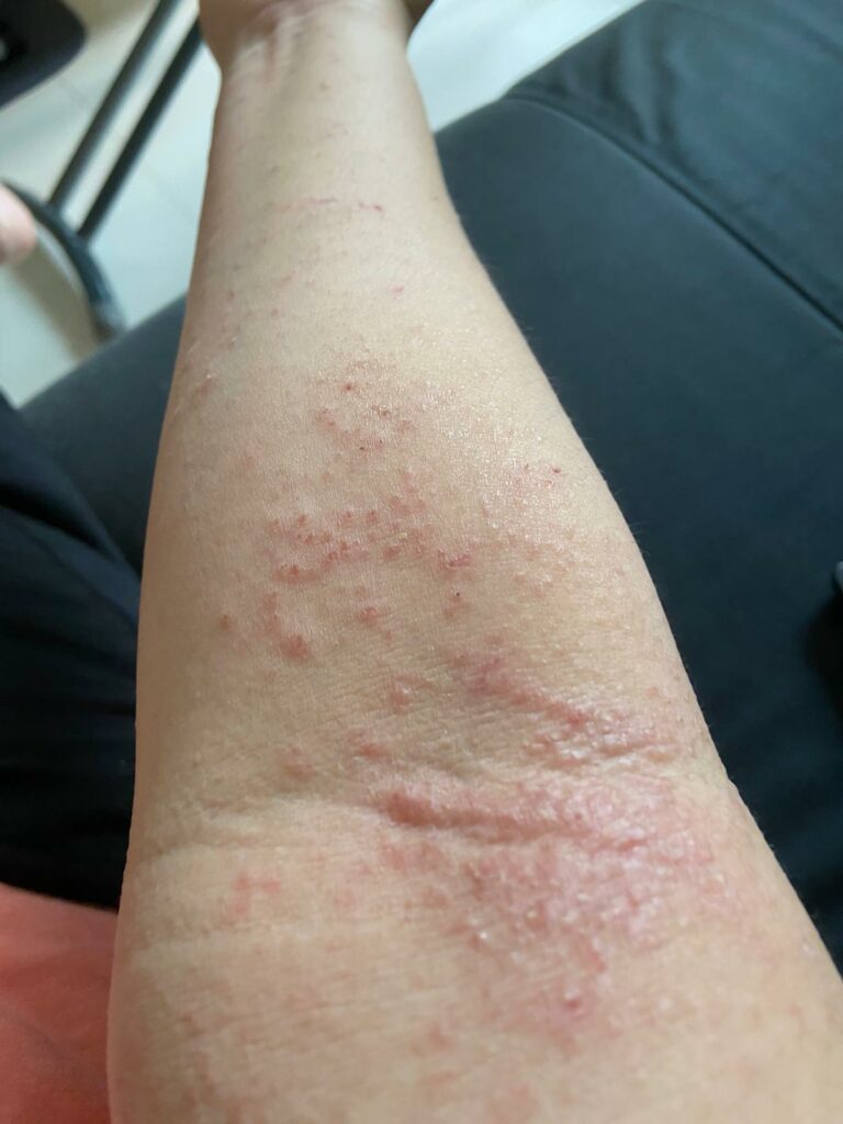 Rashes on inside store of elbows