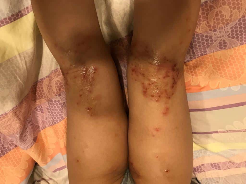 Above: Red scabs and rashes on the backs of the children knees are signs of eczema. The broken skin is trying to heal