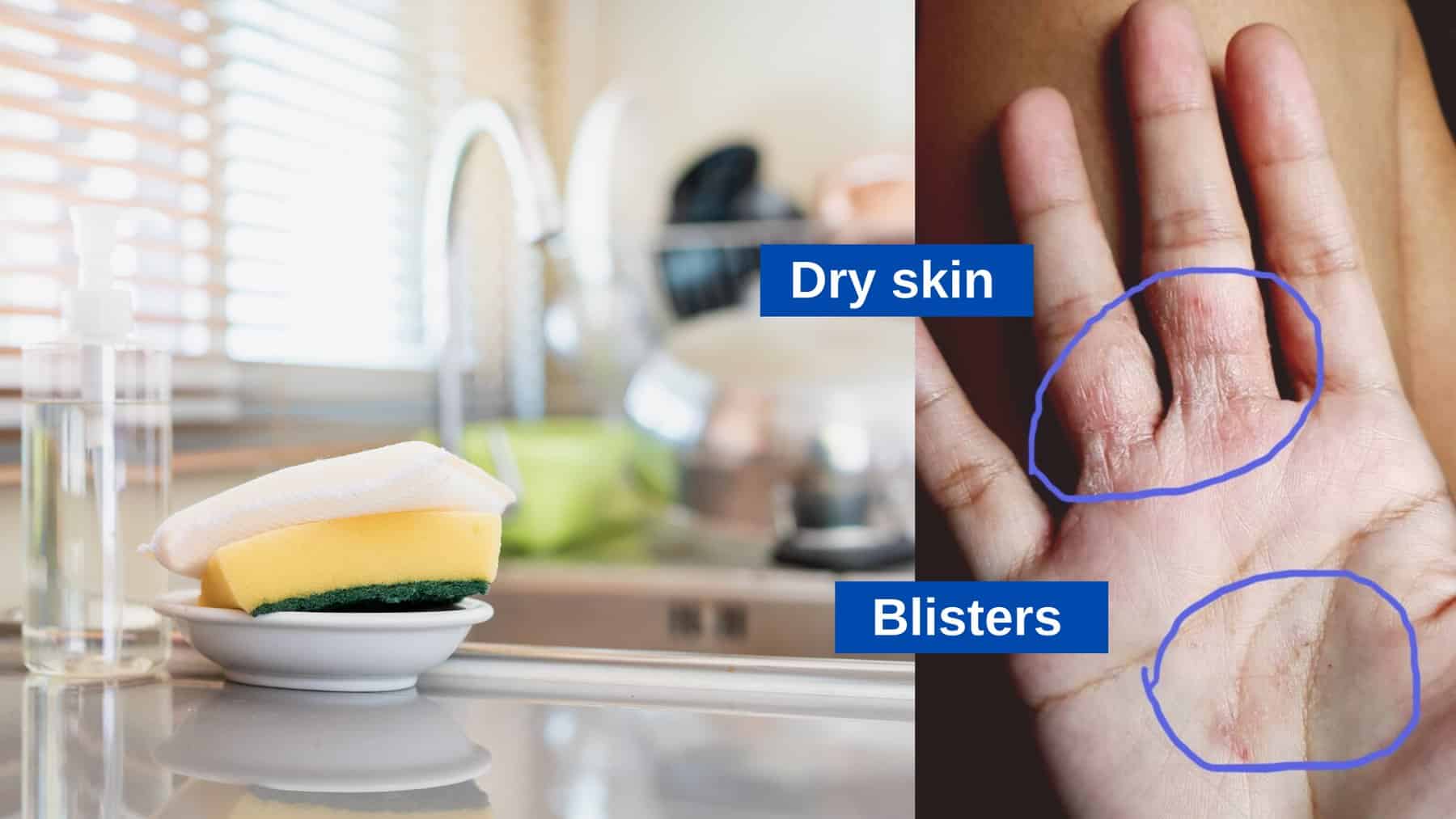 Eczema Products and TSW Solutions Skinshare Singapore