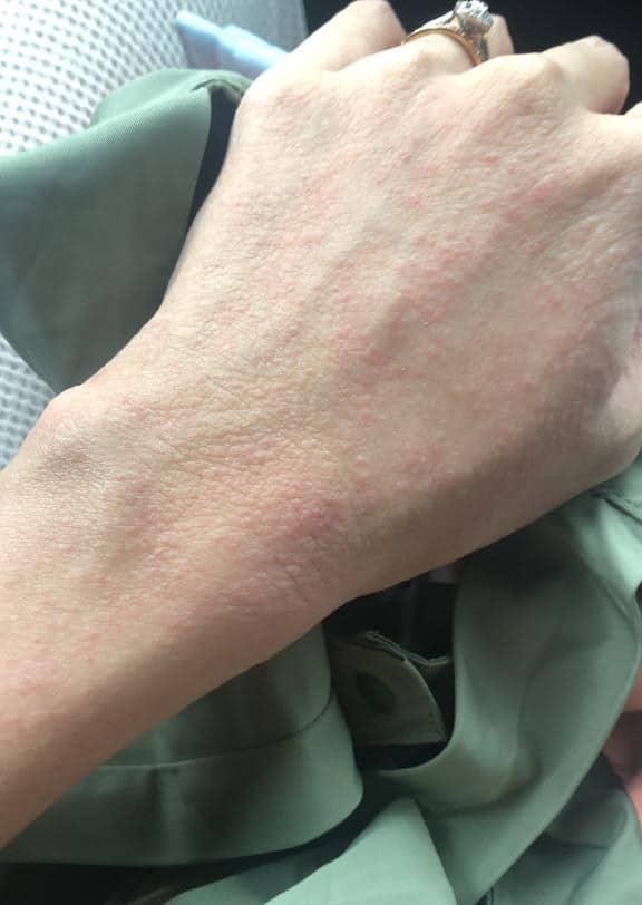 Above: Alina's hands during an eczema flareup post-pregnancy. Her skin is dry and inflamed with red itchy bumps