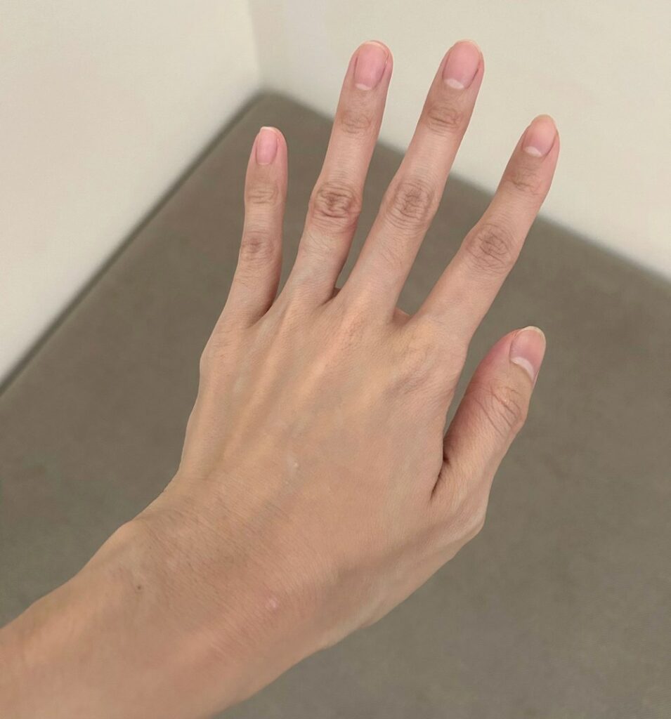 Above: Alina's hand 21 days after regular use of emu oil and Argasol silver gel 