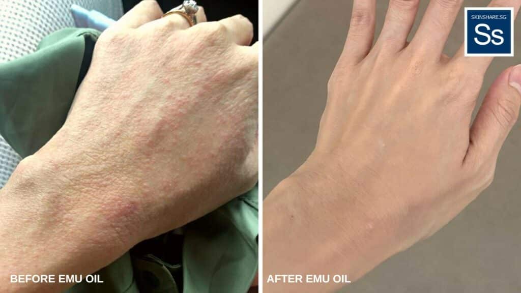 LEFT: Alina's hand eczema post-pregnancy. RIGHT: After 21 days of treatment