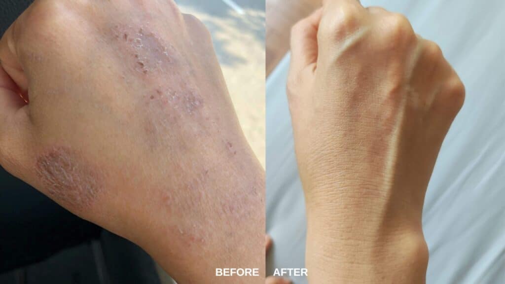 How to Lighten Eczema Scars and Prevent Further Skin Aging?  [AskSkinshareSG] - SkinshareSG