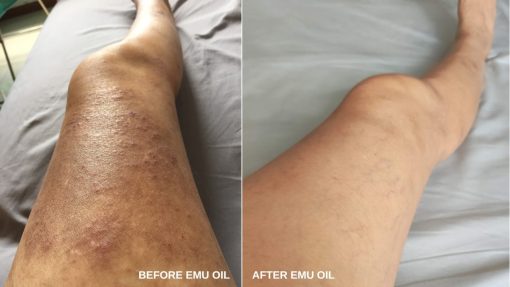 Y-Not Natural 100% Pure Emu Oil Omega 3,6 & 9 (200ml) - Image 4