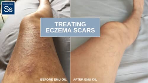 Emu oil for eczema scar treament