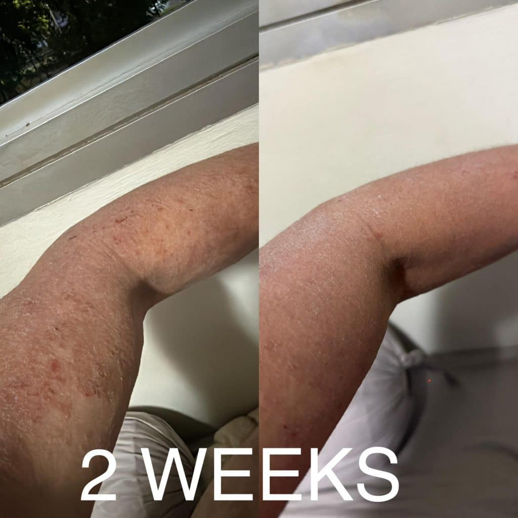 arm topical steroid withdrawal before after emu oil