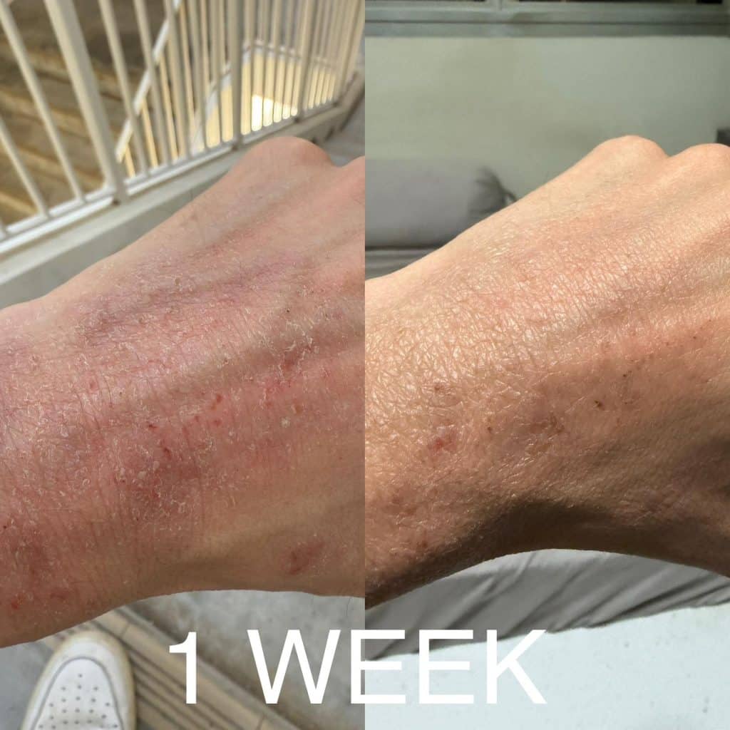 hand eczema TSW before after emu oil