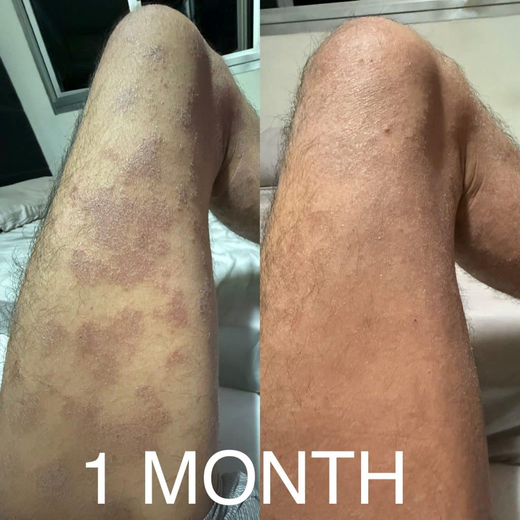 Leg and thigh TSW before after emu oil