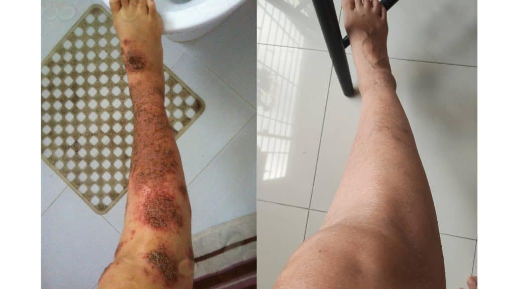 topical steroid withdrawal before and after
